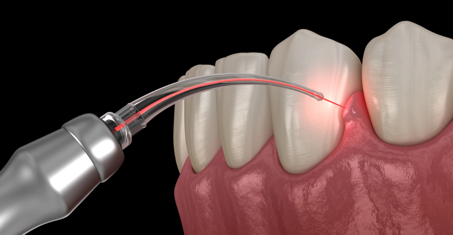 What is Laser Dentistry Inblog